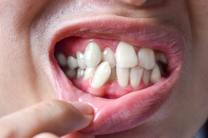 crooked teeth